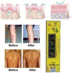 Psoriasis/exzeem Chineese Creme 13 Psoriasis/exzeem Chineese Creme -Lichaamsverzorging 1195x1200 1