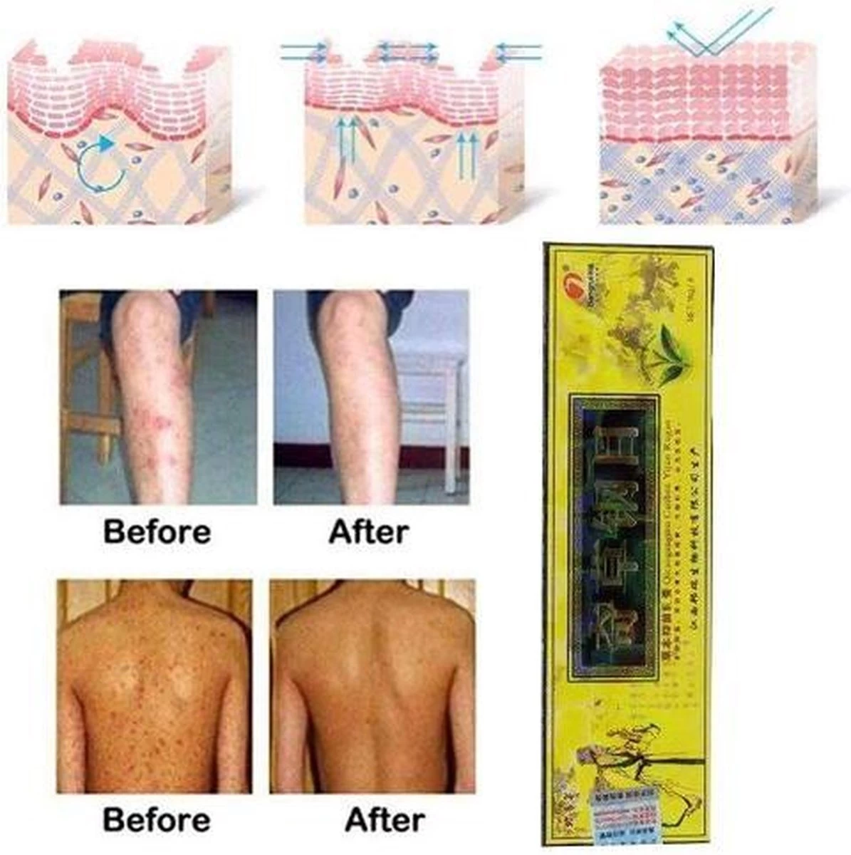 Psoriasis/exzeem Chineese Creme 4 Psoriasis/exzeem Chineese Creme - Afbeelding 4