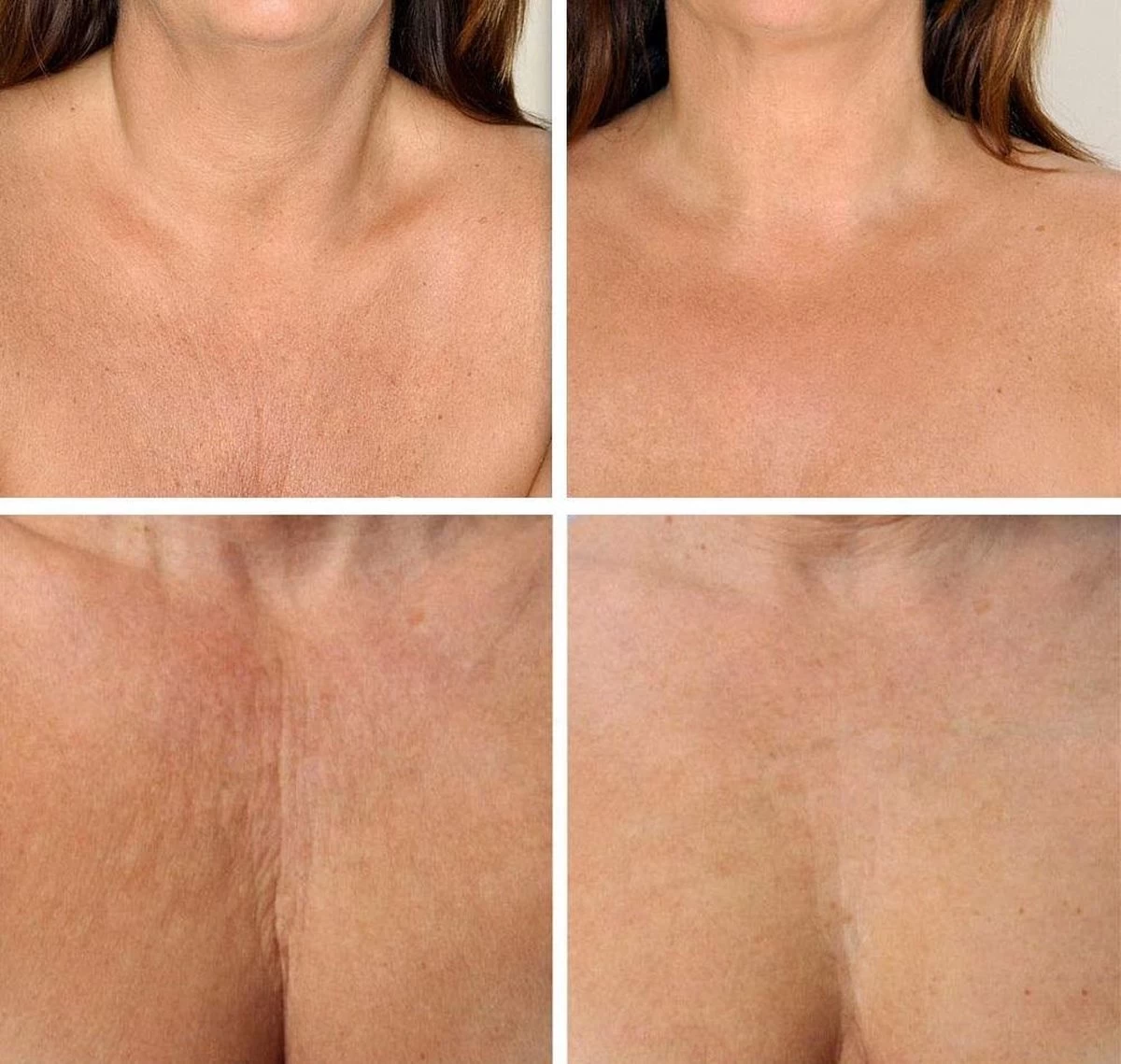 Simia™ Anti Rimpel Beauty Pads - Decolleté Large T Shape Set (2 Stuks) - Herbruikbaar Anti Aging Siliconen Pad Tegen Lijntjes En Slaaprimpels 4 Simia™ Anti Rimpel Beauty Pads - Decolleté Large T Shape Set (2 Stuks) - Herbruikbaar Anti Aging Siliconen Pad Tegen Lijntjes En Slaaprimpels - Afbeelding 4