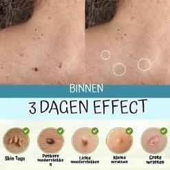 Skini™ - Moedervlekken & Wratten & Skin Tags Verwijderaar | Moedervlekken Verwijderaar | Wratten Verwijderaar | Moedervlekken Verwijderen | Wratten Verwijderen | Fibroom Verwijderen | Skin Tag Verwijderen | Steelwratjes Verwijderen -Lichaamsverzorging 1200x1200 177